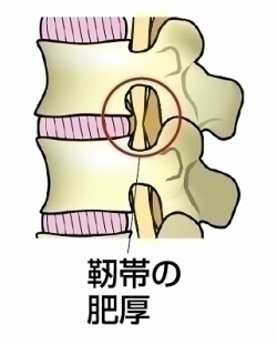 黄色靭帯骨化症とは・・・