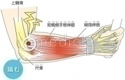 肘の痛み