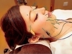 【 美容鍼・美顔鍼 】