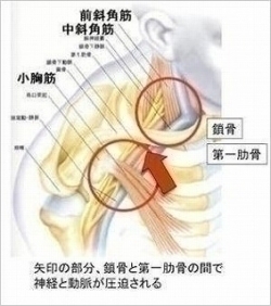 胸郭出口症候群