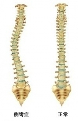 脊柱側弯症