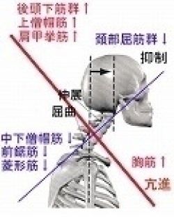 上位交差症候群
