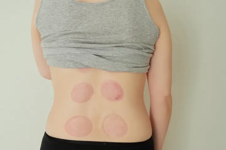 カッピングで言われる「デトックス」の正体は血行促進による老廃物の排出