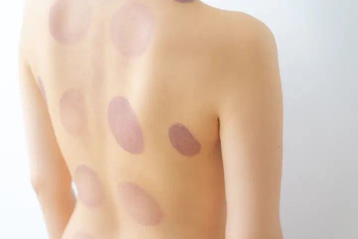 カッピング後の「跡の色」であなたの健康状態がわかる