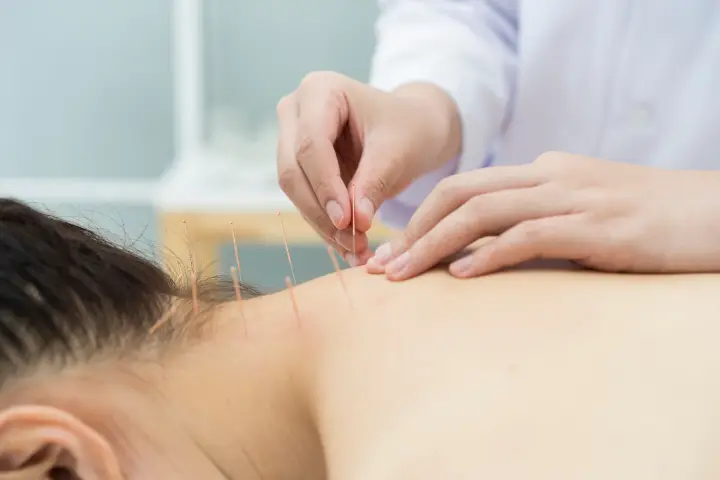 その場しのぎはもう終わり?慢性的な肩こりに鍼治療が選ばれる理由
