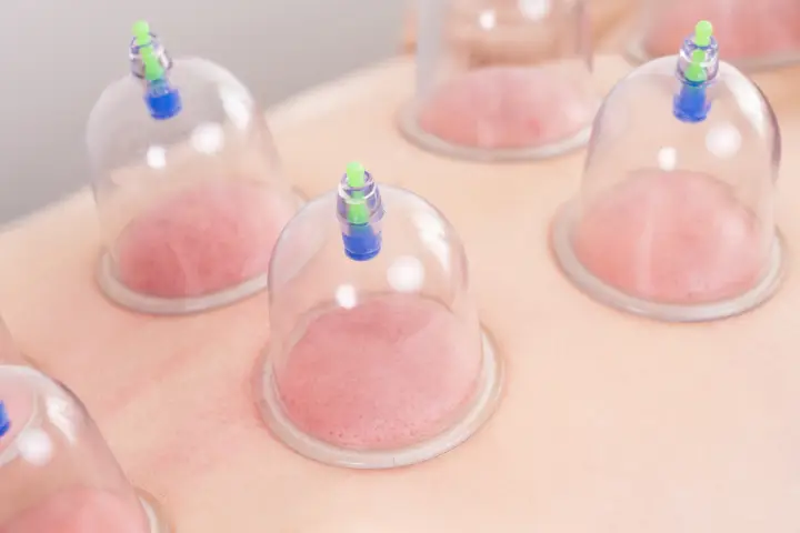 カッピング(吸い玉)の効果をプロの鍼灸師が解説